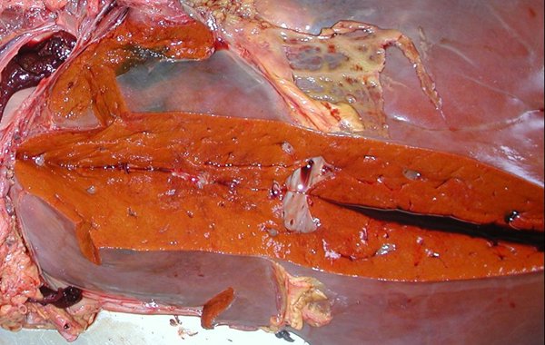 Copper poisoning
