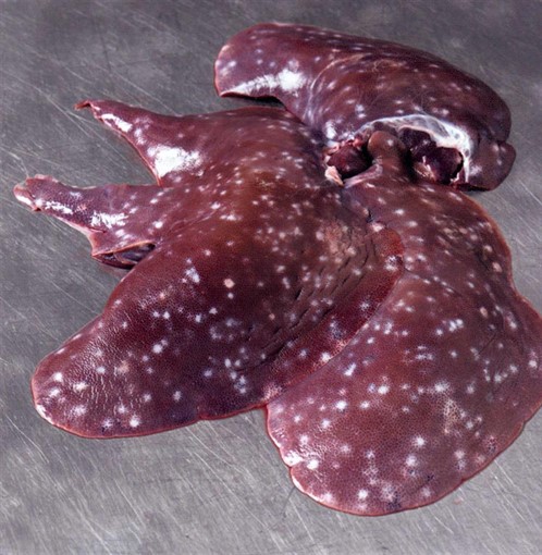 Ascariasis