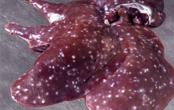 Ascariasis