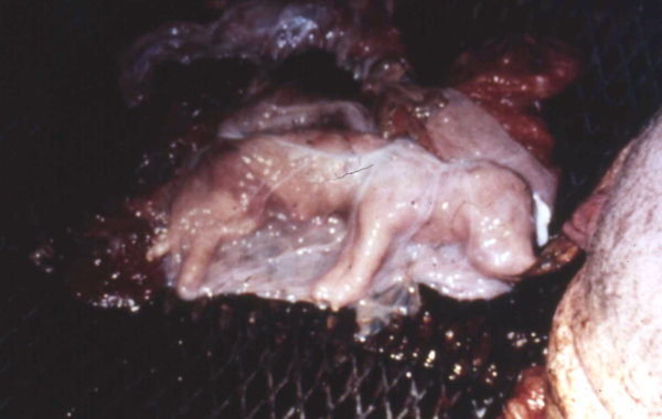 Stillbirths
